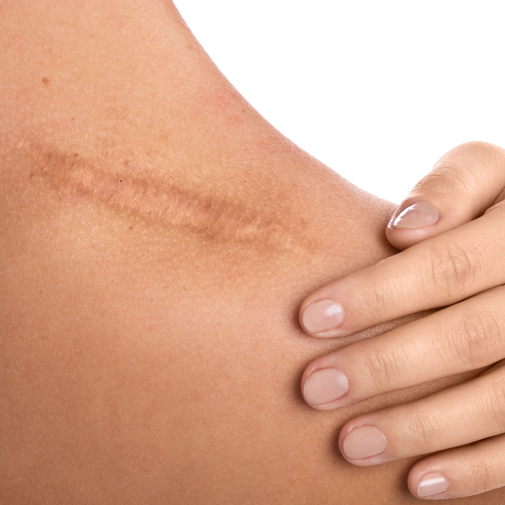 5 Tipps zur Narbenheilung mit Aloe Vera | Atlantia - atlantialoe