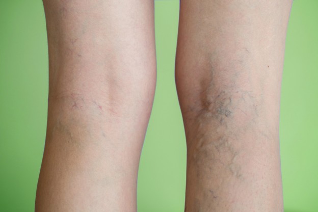 Varicose veins