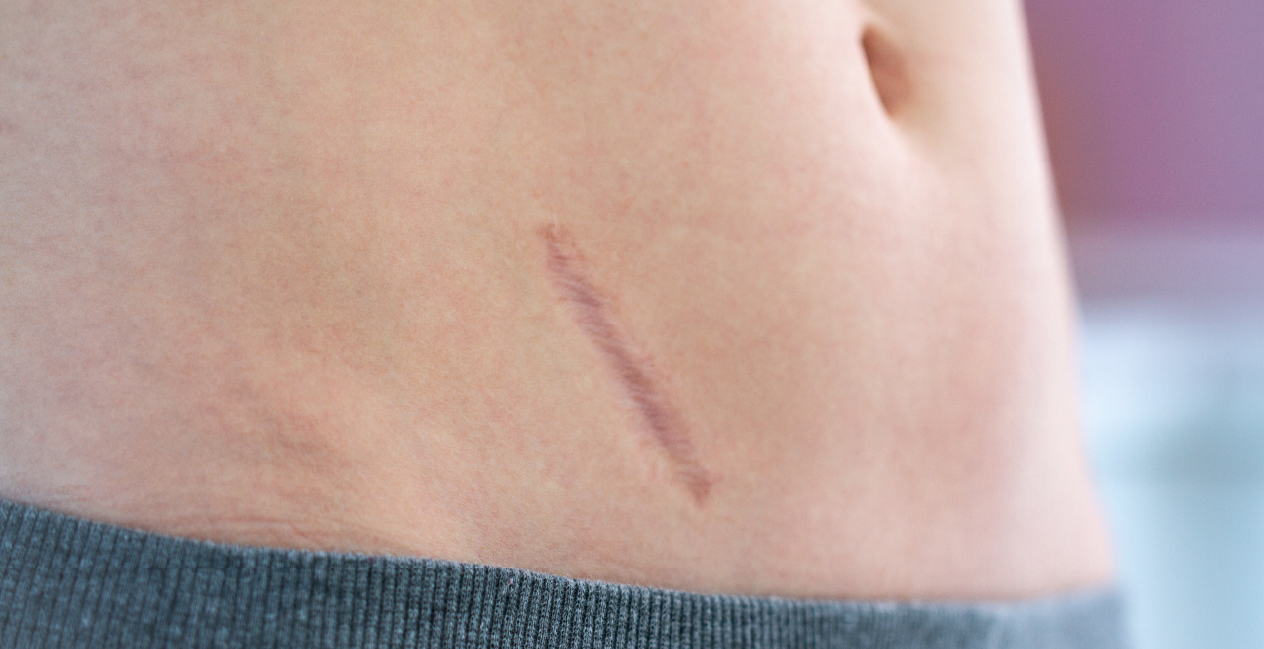 Scar healing
