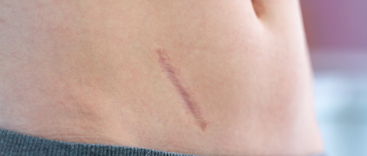 Scar healing